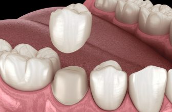 Everything about dental crown