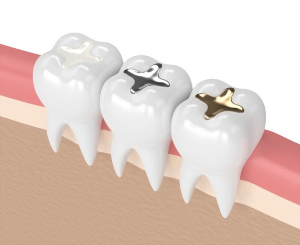 Dental Fillings 1