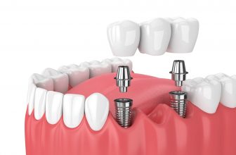 Mini Dental Implant