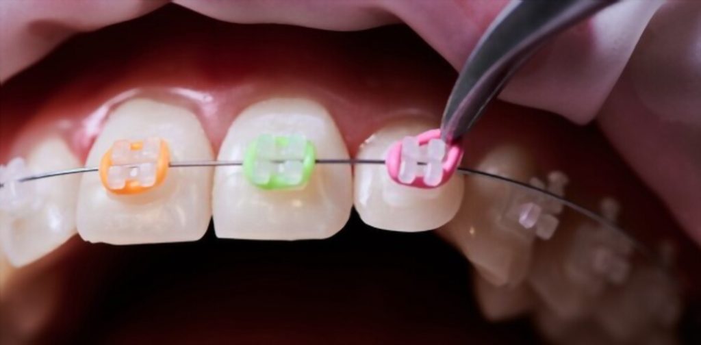 Multicolour Braces