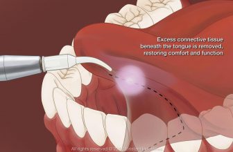 Frenectomy