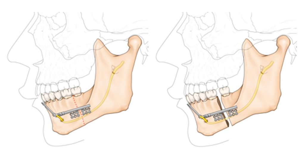 Mandibular Distraction Osteogenesis
