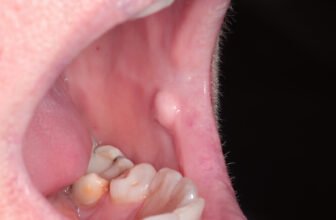 Oral Fibroma