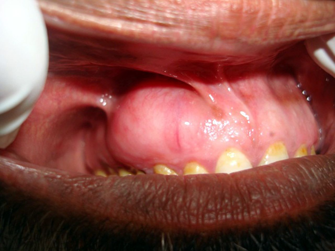 Oral Neurofibroma 4
