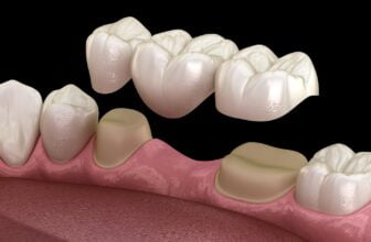 dental bridge