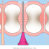 What is Calculus Bridge? Its Types, Causes, Effects, Prevention, and Treatment